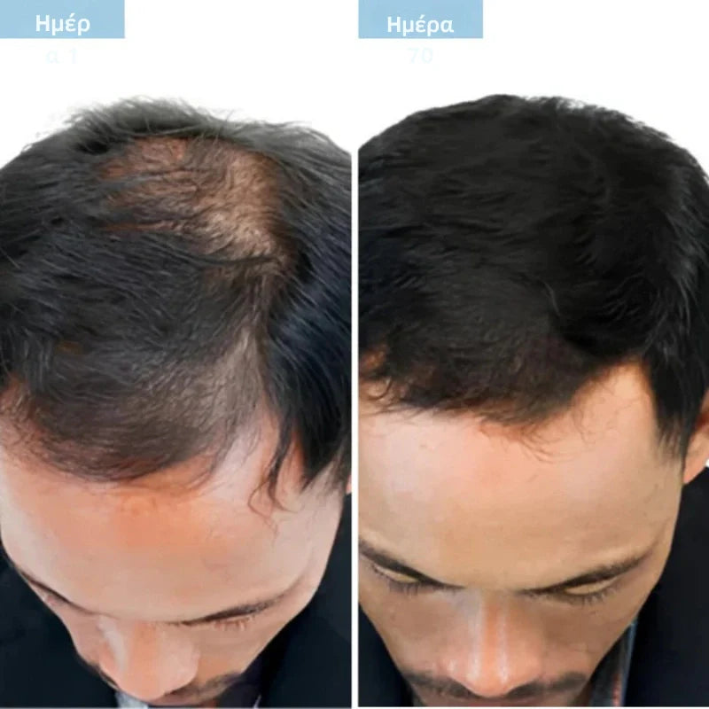 Daynava™ Roll-On για Ανάπτυξη Μαλλιών